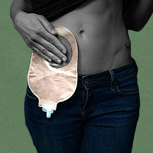 How a stoma changed my life