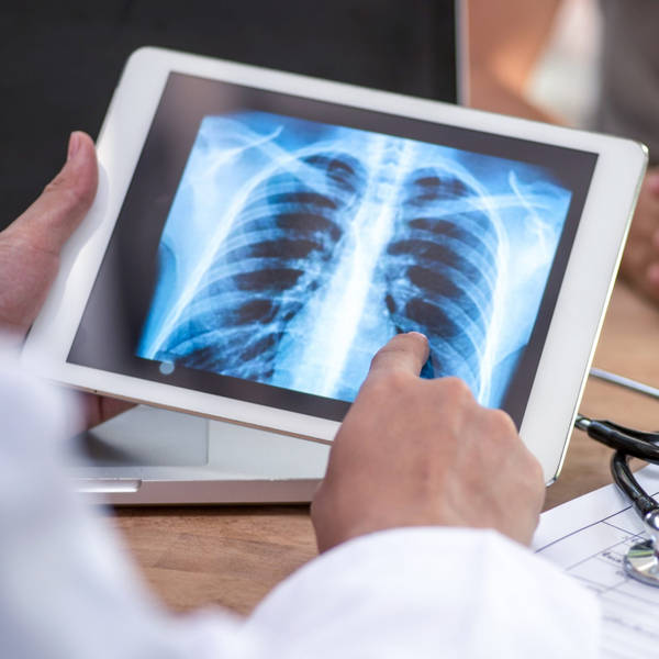 Artificial intelligence helps doctors detect lung cancer