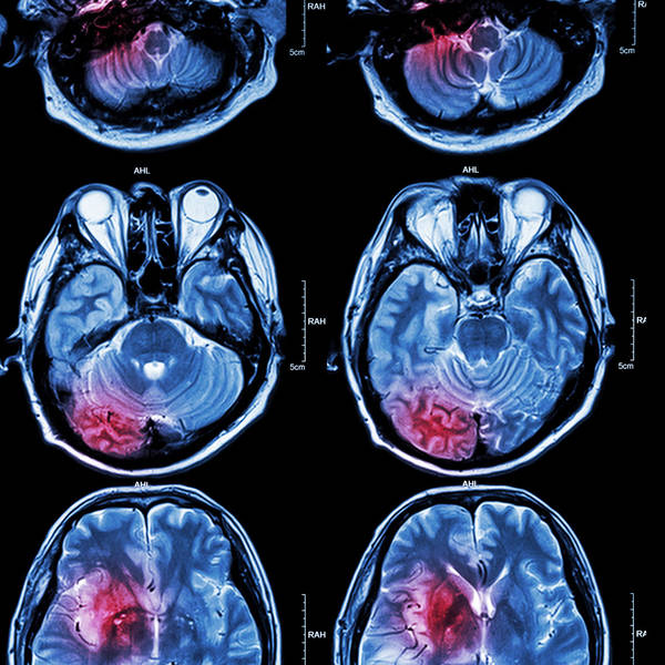 Brain stimulation aids short-term memory